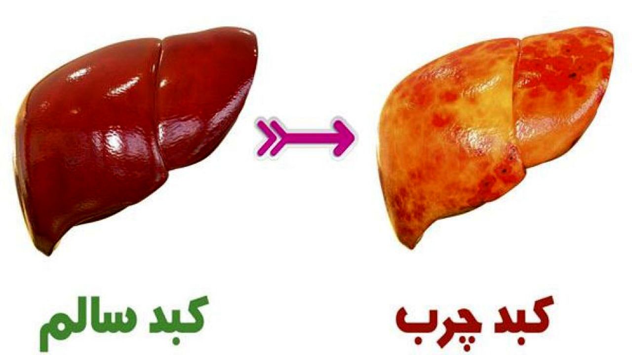 عوارض ابتلا به بیماری کبد چرب